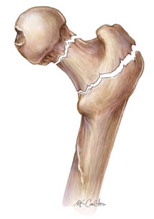 دعوة خاصة لحضور الحلقة الدراسية الثانية بعنوان:updates in osteoporosis
